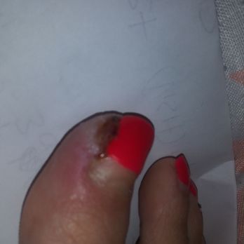 Cali Nails - Infection still two months later. They cut off all skin.had to go to hospital and get antibiotics. Dont go here if you value your safety. - Nail Salons Near Me - Idaho Falls, Idaho Cali Nails - Infection still two months later. They cut off all skin.had to go to hospital and get antibiotics. Dont go here if you value your safety. - Nail Salons Near Me - Idaho Falls, Idaho