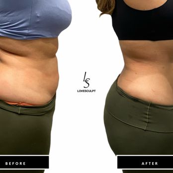 Lovesculpt - Body Contouring Near Me - Irvine, California Lovesculpt - Body Contouring Near Me - Irvine, California