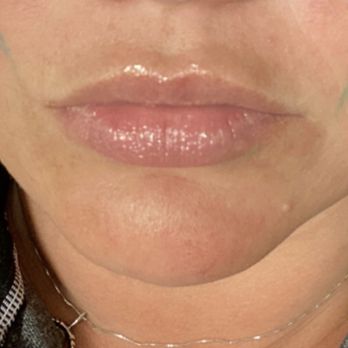 Euro Med Spa - Before filler - Medical Spas Near Me - Chattanooga, Tennessee