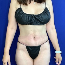 Samuel Salcedo, MD - The Plastics Doc - Tummy tuck early postop