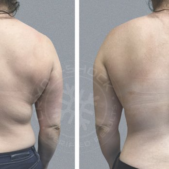 Rejuvative Therapy - Back fat removal before and after - Acupuncture Near Me - Mill Valley, California Rejuvative Therapy - Back fat removal before and after - Acupuncture Near Me - Mill Valley, California