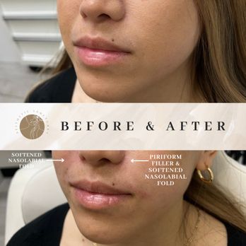 Aesthetic Sanctuary - Softened nasolabial folds - Medical Spas Near Me - Honolulu, Hawaii Aesthetic Sanctuary - Softened nasolabial folds - Medical Spas Near Me - Honolulu, Hawaii