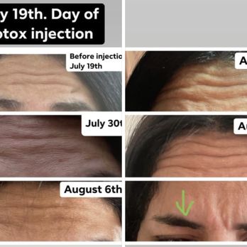Vitenas Cosmetic Surgery - Horrible Botox. - Cosmetic Surgeons Near Me - Houston, Texas Vitenas Cosmetic Surgery - Horrible Botox. - Cosmetic Surgeons Near Me - Houston, Texas
