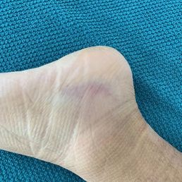 Before treatment Before treatment