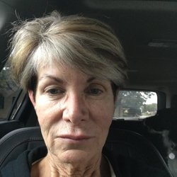 Illume Cosmetic Surgery & MedSpa - Before neck and mini face lift