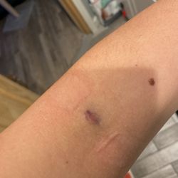 Labcorp - This is the work of a bad phlebotomist.