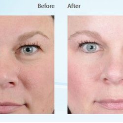 The Bengtson Center for Aesthetics and Plastic Surgery - Eyelid Surgery - Patient #3029 Frontal Before & After