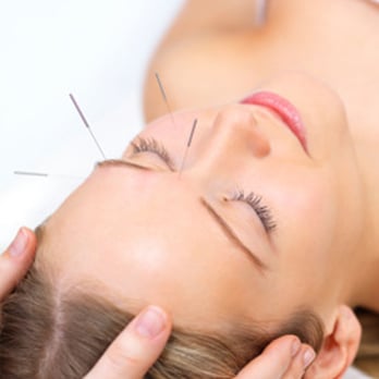 David Shevick, L.Ac . - Acupuncture needles - Acupuncture Near Me - San Rafael, California David Shevick, L.Ac . - Acupuncture needles - Acupuncture Near Me - San Rafael, California