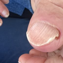 Paronychia of left thumb that was drained by the ER doctor then given cephalexin antibiotics Paronychia of left thumb that was drained by the ER doctor then given cephalexin antibiotics