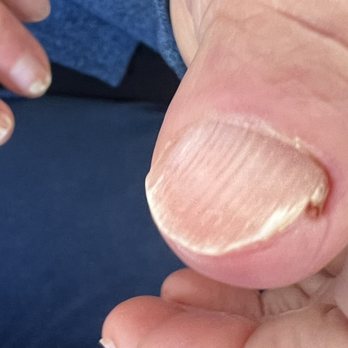 Galaxy Nail Spa - Paronychia of left thumb that was drained by the ER doctor then given cephalexin antibiotics - Nail Salons Near Me - Walnut Creek, California Galaxy Nail Spa - Paronychia of left thumb that was drained by the ER doctor then given cephalexin antibiotics - Nail Salons Near Me - Walnut Creek, California