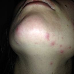 infection and acne after facial wax here. only happened here