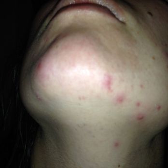 Heritage Threading Salon - infection and acne after facial wax here. only happened here - Threading Services Near Me - Brookline, Massachusetts