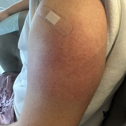 Progressive swallowing taking over my entire arm leaving my left arm without mobility and EXTREMELY sensitive and painful. Progressive swallowing taking over my entire arm leaving my left arm without mobility and EXTREMELY sensitive and painful.