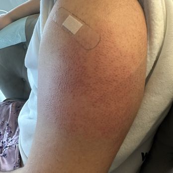 CVS Pharmacy - Progressive swallowing taking over my entire arm leaving my left arm without mobility and EXTREMELY sensitive and painful. - Drugstores Near Me - Los Angeles, California CVS Pharmacy - Progressive swallowing taking over my entire arm leaving my left arm without mobility and EXTREMELY sensitive and painful. - Drugstores Near Me - Los Angeles, California
