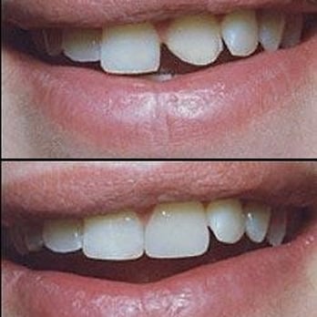 Sassan Rastegar, DDS - Bonding, before and after shot
- Cosmetic Dentists Near Me - New York, New York Sassan Rastegar, DDS - Bonding, before and after shot
- Cosmetic Dentists Near Me - New York, New York