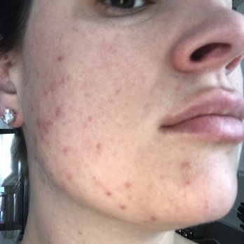 Ego Medical Aesthetics - Bacterial infection confined by my MD and now being treated by topical antibiotic...I did not have this before going to EGO - Medical Spas Near Me - Gilbert, Arizona Ego Medical Aesthetics - Bacterial infection confined by my MD and now being treated by topical antibiotic...I did not have this before going to EGO - Medical Spas Near Me - Gilbert, Arizona