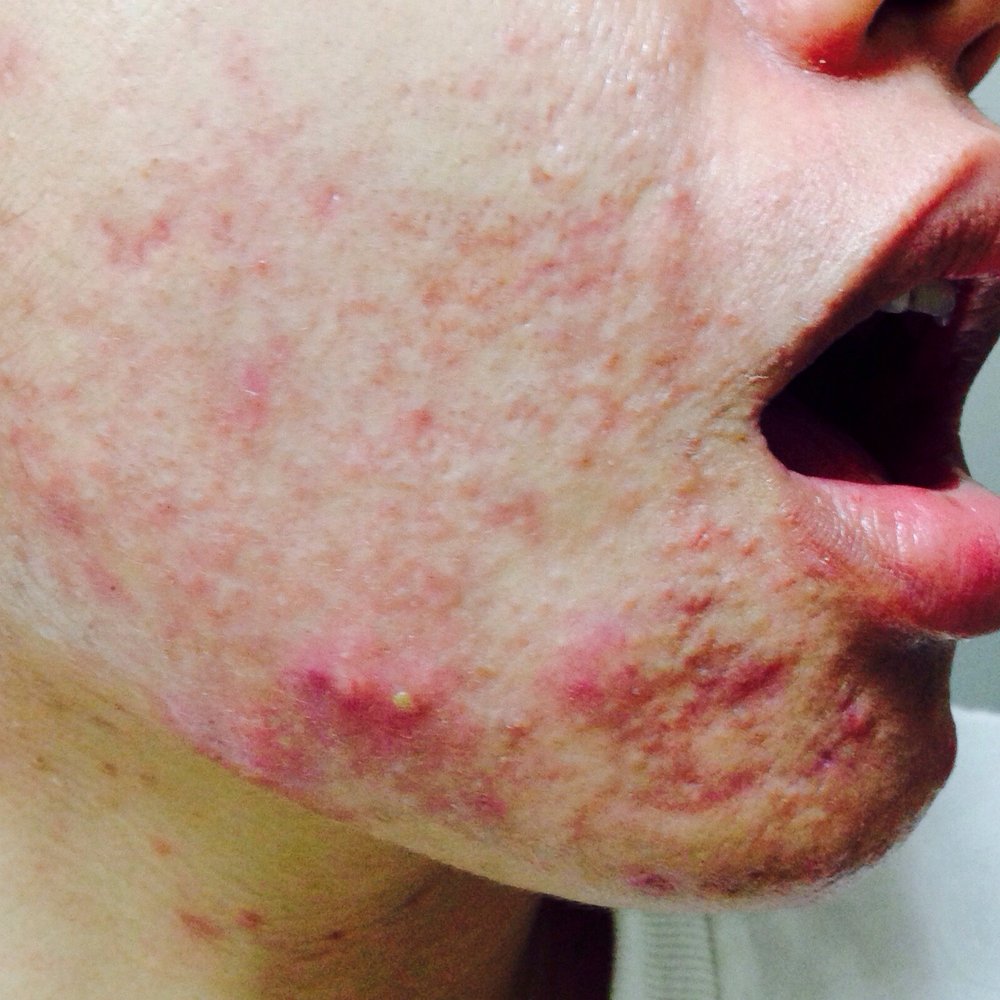 My skin right now. I've had two chemical peels and nothing seems to work on these clogged pores all over my chin My skin right now. I've had two chemical peels and nothing seems to work on these clogged pores all over my chin