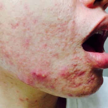 From Head To Toe - My skin right now. I've had two chemical peels and nothing seems to work on these clogged pores all over my chin - Skin Care Near Me