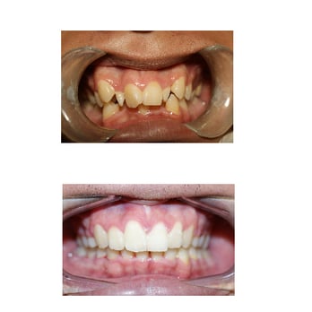 Ipro Dental - Before and after braces. - General Dentistry Near Me - Cupertino, California Ipro Dental - Before and after braces. - General Dentistry Near Me - Cupertino, California