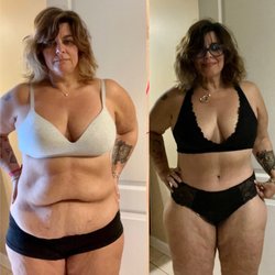 Cosmetic Surgery Affiliates - 360 lift day of surgery and 2 months after