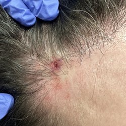Bosley Hair Restoration & Transplant