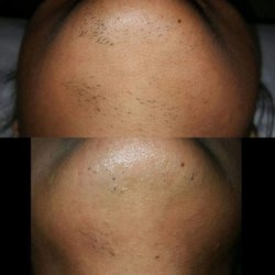 Perfection Electrolysis - Laser hair removal