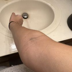 Capital Women's Care - Bruised veins from improperly taking my blood.
