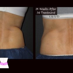 Elite Salon And Medspa - CoolSculpting