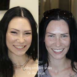 Laguna Dental Center - What a great change in the smile! We got the patients teeth to be healthy and got a great look with a combination of veneers and crowns