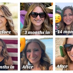 Prose Orthodontics - Braces Journey and face/smile changes