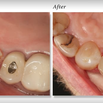 Fred Chao, DDS - Severely fractured tooth replaced with all porcelain crown (view from below). - General Dentistry Near Me - Los Angeles, California Fred Chao, DDS - Severely fractured tooth replaced with all porcelain crown (view from below). - General Dentistry Near Me - Los Angeles, California