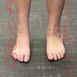 MidJersey Orthopaedics - Foot on the left first on that was operated picture taken at final post operation visit. Foot on the right is not operated yet.