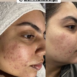Omra Salon and Medspa - Acne treatment
