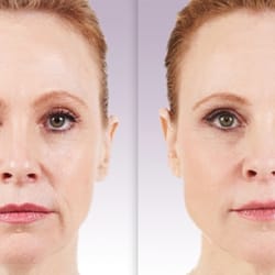 Renu Facial And Body Aesthetics - Before & After Voluma