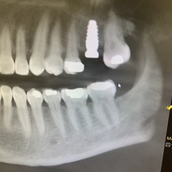 Elite Care Dental - Implant placed to get pt her bite back to normal