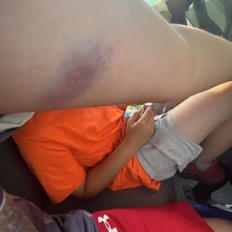 This is the bruise I got from the beast This is the bruise I got from the beast
