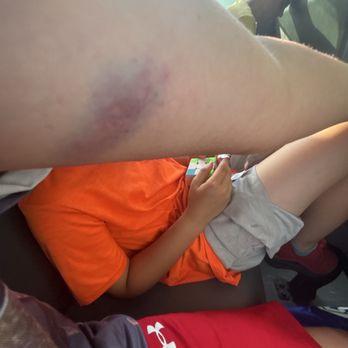 Kings Island - This is the bruise I got from the beast - Amusement Parks Near Me - Kings Mills, Ohio Kings Island - This is the bruise I got from the beast - Amusement Parks Near Me - Kings Mills, Ohio