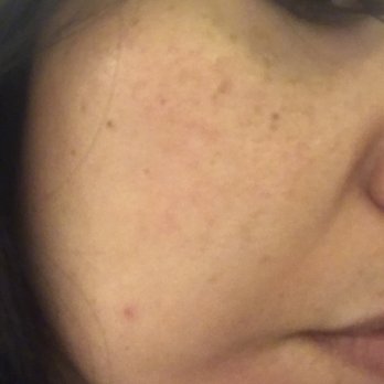 Skin And Brows By Cali Truong - Redness from the peel and blackhead extraction subsided in about 48 hours. - Skin Care Near Me - Placentia, California