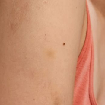 Nuad Royal Thai Spa - Bruise on upper arm - Massage Near Me - Los Angeles, California