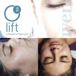 Ashley Esthetics - O2 Lift using Image