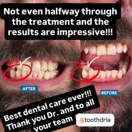 This is me, 4 months into my invisialign treatment, not even halfway through and my crooked teeth are becoming a new smile This is me, 4 months into my invisialign treatment, not even halfway through and my crooked teeth are becoming a new smile