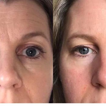 Incantare Aesthetics - The magic of Microneedling! The Best anti aging service in the treasure valley! Medical grade ampules always used, come book a treatment! :) - Estheticians Near Me - Boise, Idaho Incantare Aesthetics - The magic of Microneedling! The Best anti aging service in the treasure valley! Medical grade ampules always used, come book a treatment! :) - Estheticians Near Me - Boise, Idaho