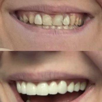Sam Hanna, DMD - Before & After - General Dentistry Near Me - Milford, Massachusetts