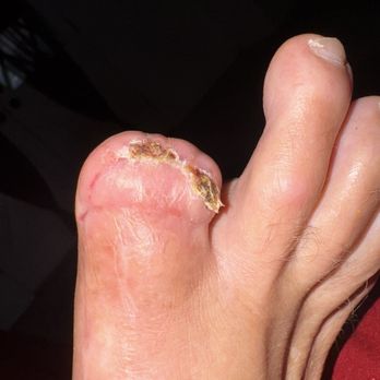 David Soomekh | Foot and Ankle Specialty Group - What I was left with. - Podiatrists Near Me - Beverly Hills, California