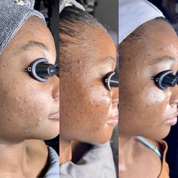 Customized acne treatments including peels--work in progress