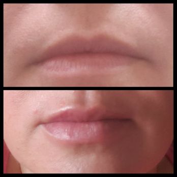 Ageless Medspa - Before (top) & Bottom (after) Day 1 after getting my lips filled. - Medical Spas Near Me - Chicago, Illinois