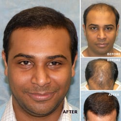 Bernstein Medical - Center for Hair Restoration - Patient UAR - see his photos here: https://www.bernsteinmedic­al.com/hair-transplant-photos/portraits/patient-uar/