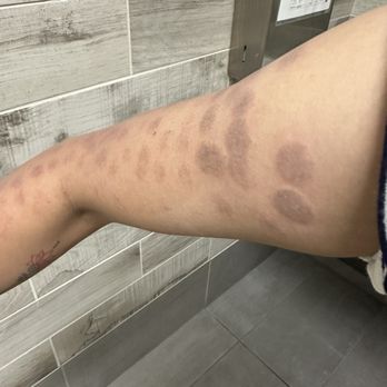 LaserAway - This is how it got after an hour or so. - Laser Hair Removal Near Me - Milpitas, California