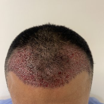 Neopel - Hair Loss Centers Near Me - Tijuana, BCN