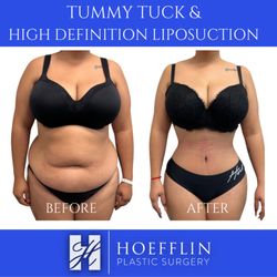 Hoefflin Plastic Surgery - Dr. Hoefflin performs a specialized highly sculpted abdominoplasty (tummy tuck) procedure, including high definition liposuction of waists.